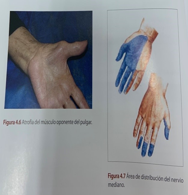 Imagen 4 Síndrome del Túnel Carpiano